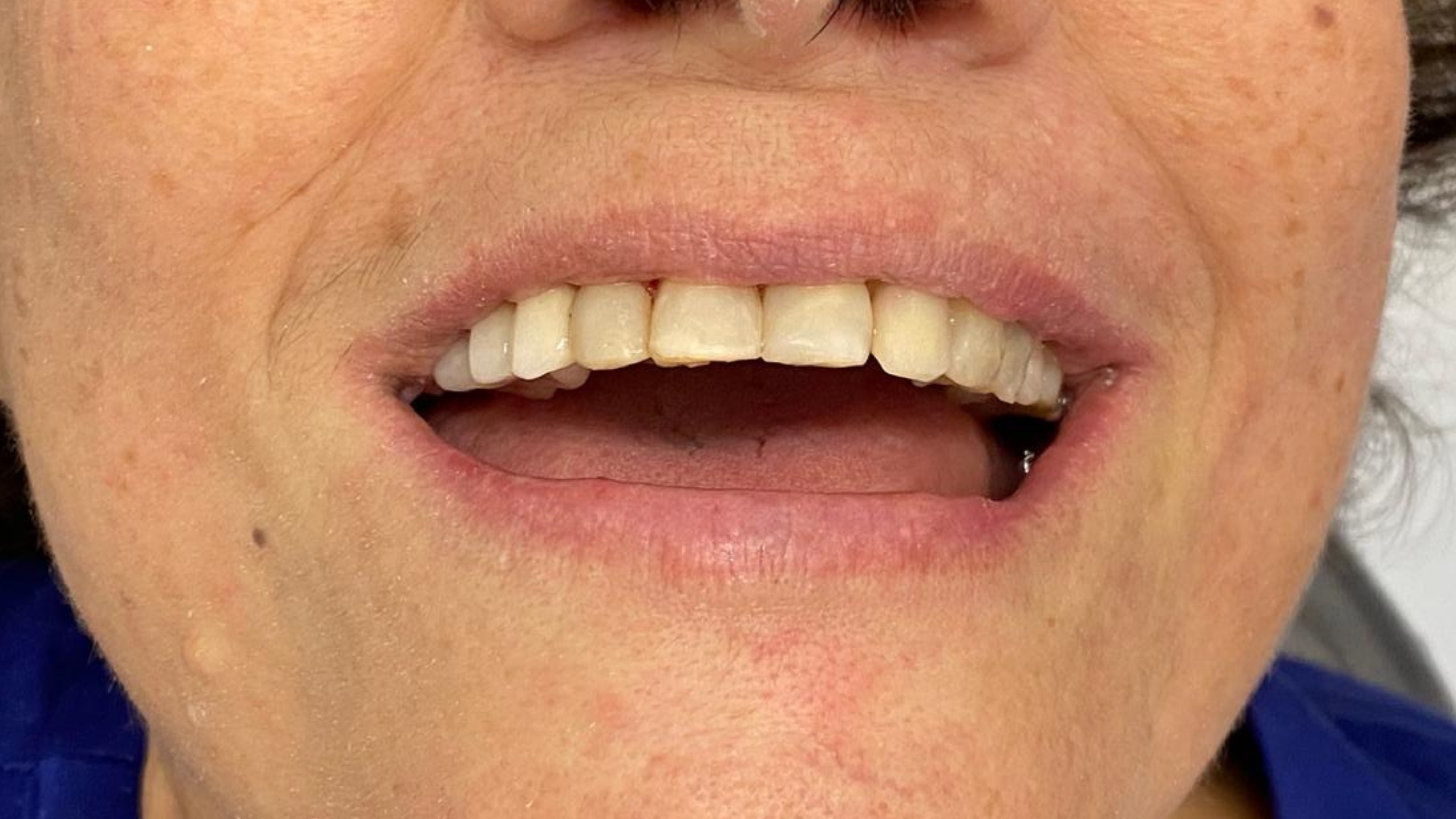 Before and After 2