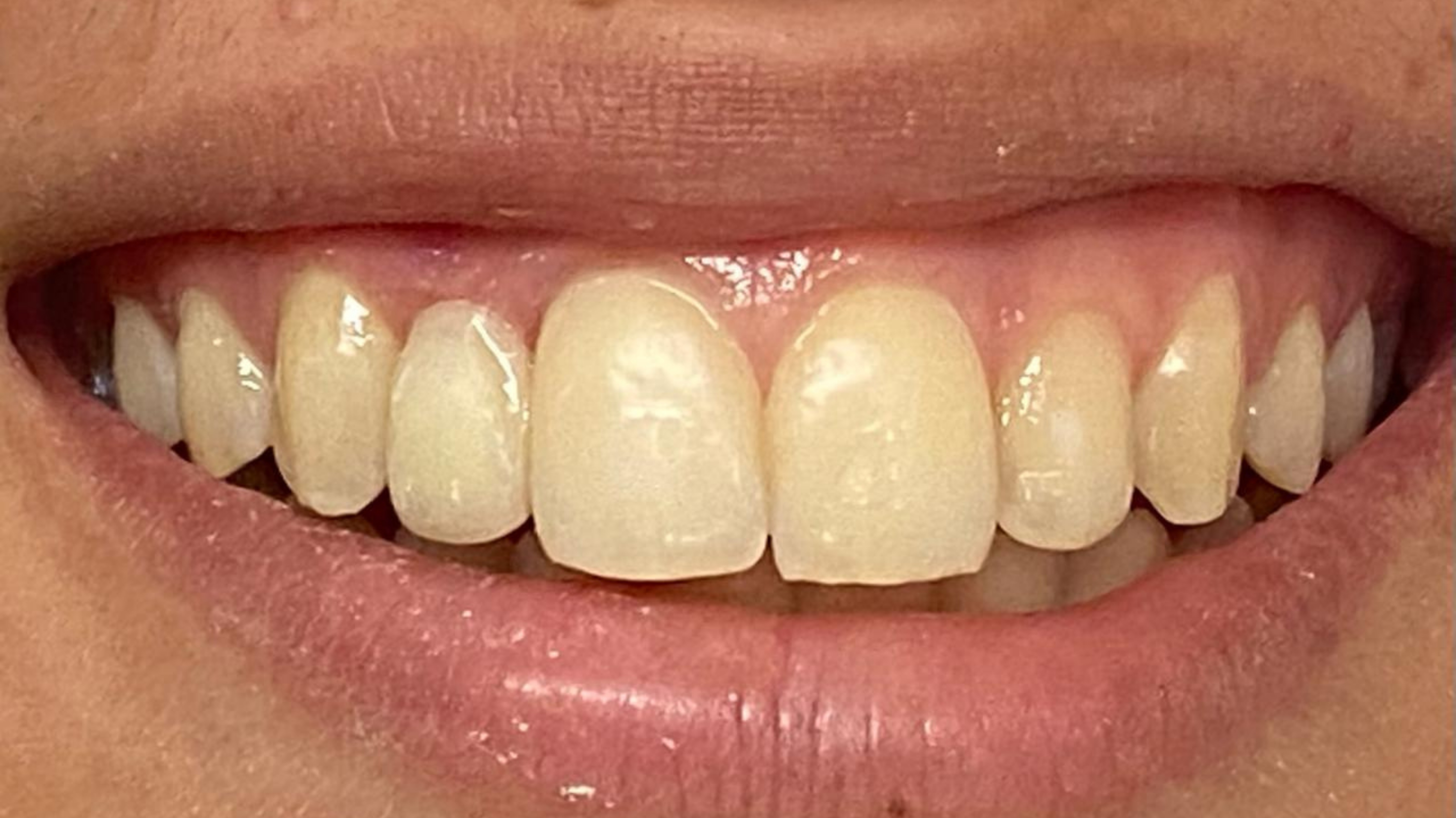 Before and After 4